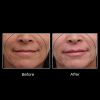 OxyGeneo® 3-in-1 Super Facial 