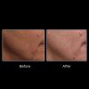 OxyGeneo® 3-in-1 Super Facial 