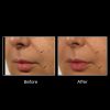 OxyGeneo® 3-in-1 Super Facial 