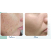 IPL Before and After 1