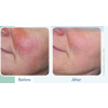 IPL Before and After 3