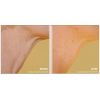Pellevé Skin Tightening Before & After Neck 2