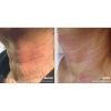 Pellevé Skin Tightening Before & After Neck 1
