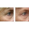 Pellevé Skin Tightening Before & After Eyes 2