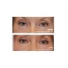 Pellevé Skin Tightening Before & After Eyes 1