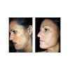 The Perfect Derma™ Peel  Before & After 2