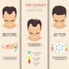 prp-hair-loss-new