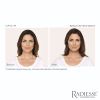 RADIESSE® (+) Volumizing Filler Before and After