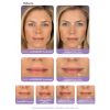 Juvederm - Rebecca