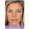 Juvederm XC