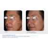 Resurfx before & after 5