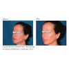 Resurfx before & after 2