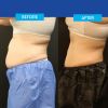 CoolSculpting® Elite Consultation