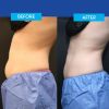 CoolSculpting® Elite Consultation