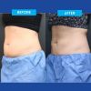 CoolSculpting® Elite Consultation