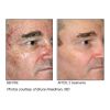 Micro Laser Peel before & after 1