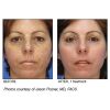 Micro Laser Peel before & after 2
