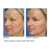 Micro Laser Peel before & after 3