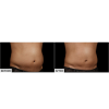 SculpSure® Before & After