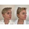 sculptra_sculptra_66326