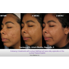 Silkpleel DERMALINFUSION Before & After