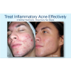 Silkpleel DERMALINFUSION Before & After