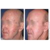 ProFractional™ Therapy