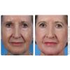 ProFractional™ Therapy