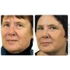 ProFractional™ Therapy