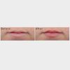SkinMedica® HA5 Smooth & Plump Lip System Before & After