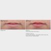 SkinMedica® HA5 Smooth & Plump Lip System Before & After
