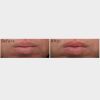 SkinMedica® HA5 Smooth & Plump Lip System Before & After