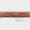 SkinMedica® HA5 Smooth & Plump Lip System Before & After