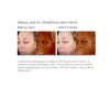 SkinMedica Vitalize Peel B&A
