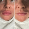 Snow Lips Treatment