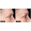 Thermage B&A