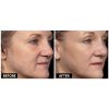 Thermage B&A