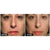 Thermage B&A