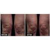 Thermage B&A