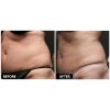 Thermage B&A