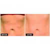Thermage B&A