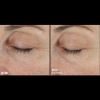 Skinbetter Science® Trio Rebalancing Moisture Treatment™ FACE Before & After