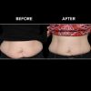 BTL VANQUISH ME™ Before and After