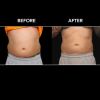 BTL VANQUISH ME™ Before and After
