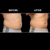 BTL VANQUISH ME™ Before and After
