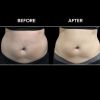 BTL VANQUISH ME™ Before and After