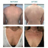 Vi Peel Body