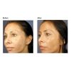Vi Peel Acne