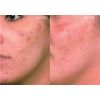Vi Peel Acne