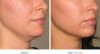 Ultherapy Before and After 1